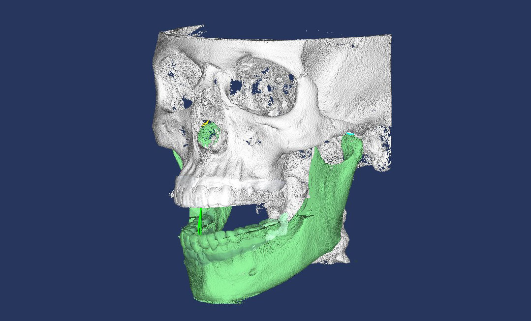 Mandible Segmentation